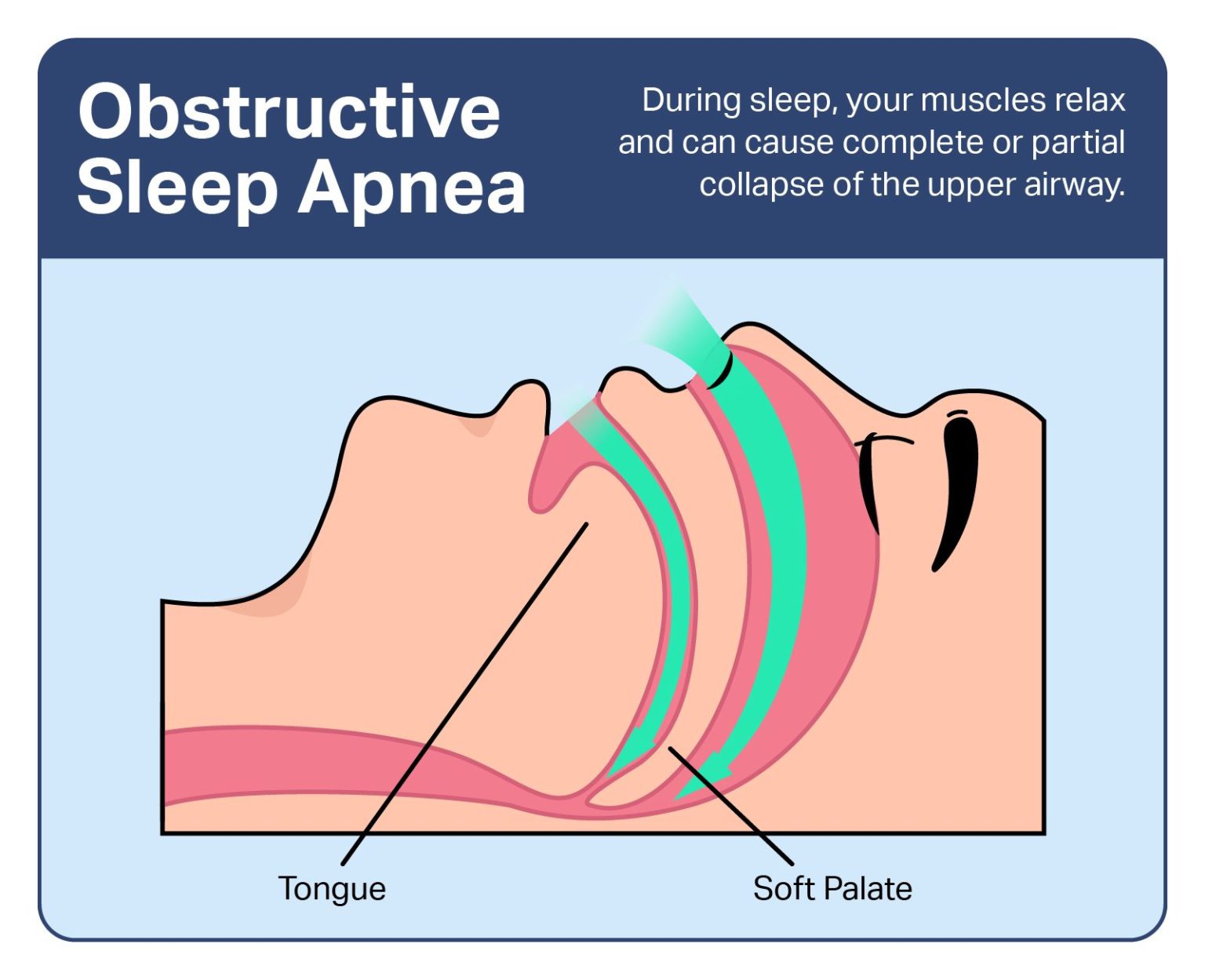 Obstructive Sleep Apnea Symptoms Causes And Treatments