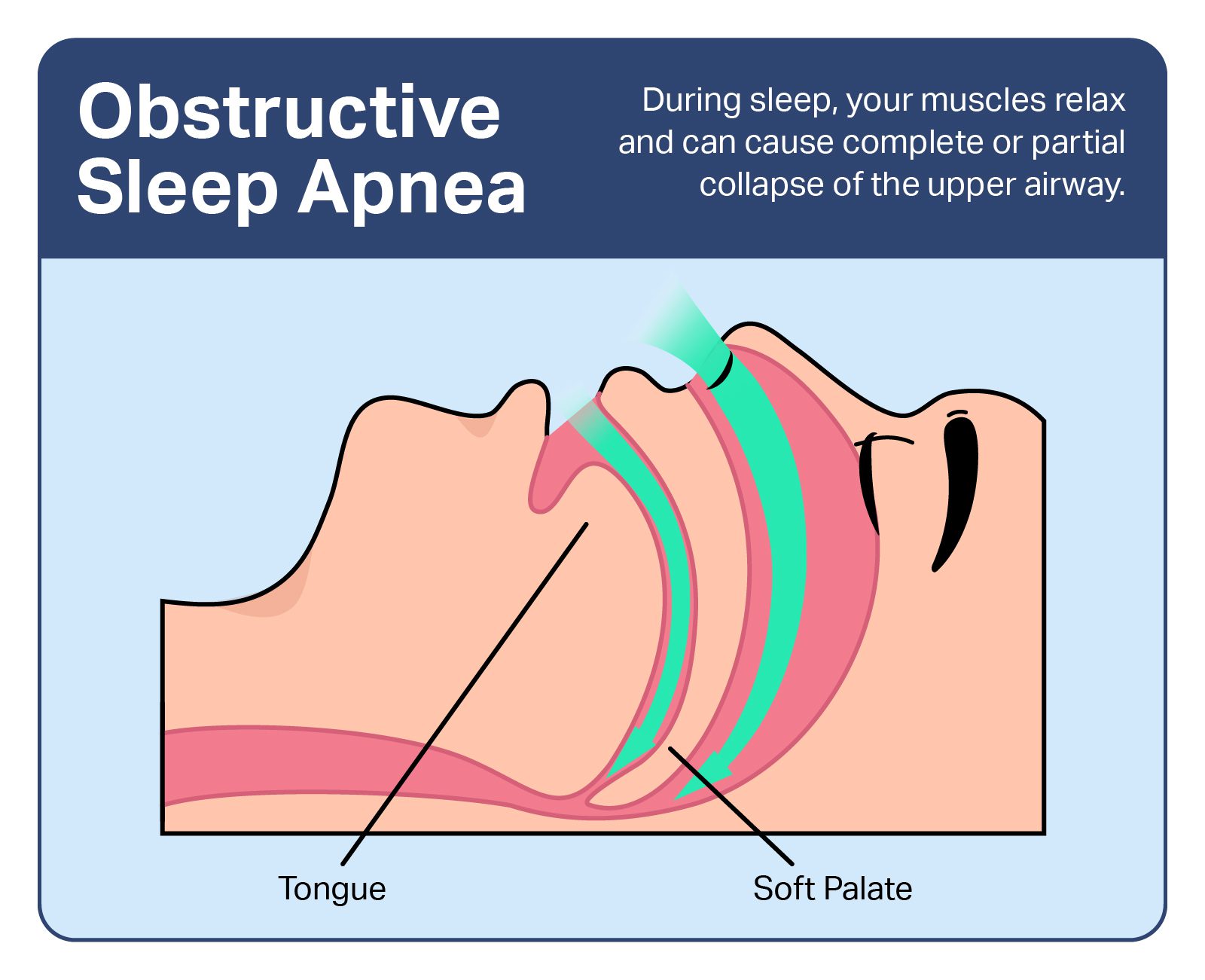 Obstructive Sleep Apnea Symptoms Causes And Treatments 5300