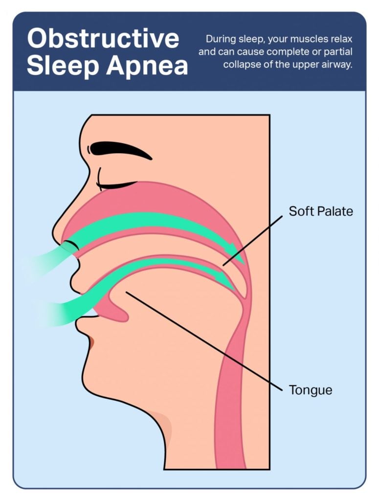 The health effects of sleep apnea: serious risks