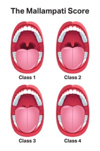 Mallampati Score and Predicting Sleep Apnea | Sleep Foundation