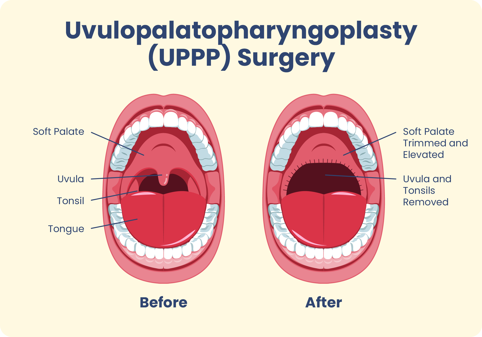 What Is Uppp Surgery 